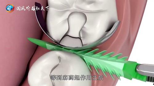 拔牙视频全过程,拔牙手术的惊心动魄瞬间
