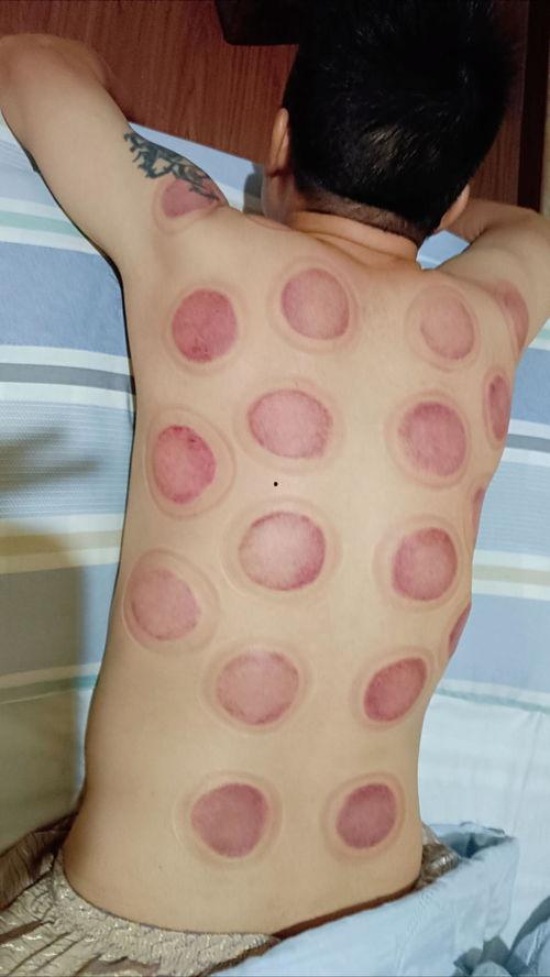 拔罐视频,揭秘拔罐神奇疗效的瞬间