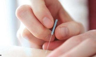 静脉曲张放血视频,直观视频解析