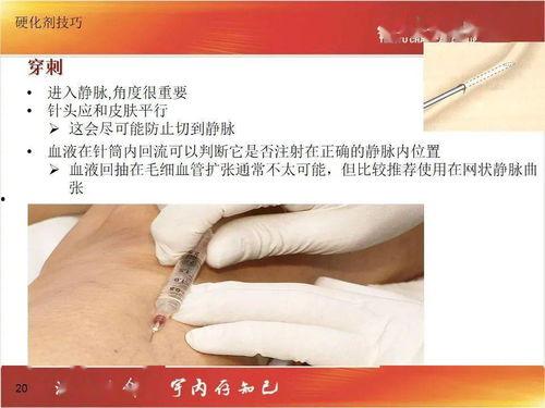 静脉曲张放血视频,直观视频解析