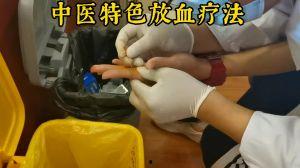放血疗法视频,传统中医与现代视角下的神奇疗愈之道