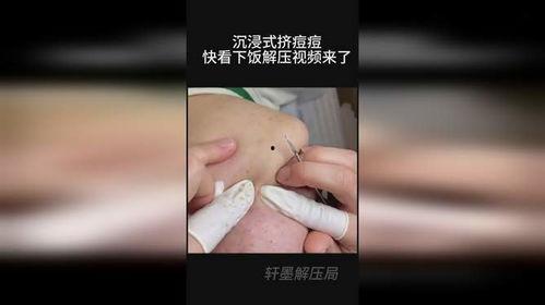 挤痘痘视频,专业视频教你正确操作