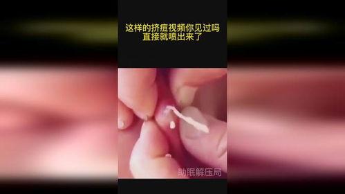 挤痘痘视频,专业视频教你正确操作