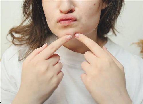 挤痘痘视频,专业视频教你正确操作